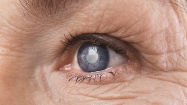 Eurostat: Cea mai frecventă procedură chirurgicală efectuată în spitalele din UE în 2023 a fost operaţia de cataractă / România, cea mai mică rată la 100.000 de locuitori /  Peste un milion de cezariene în UE, cele mai multe în Cipru şi România
