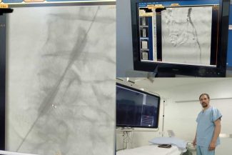 Buzău: Intervenție în premieră pentru desfundarea unei artere a piciorului; a fost montat un stent pe balon