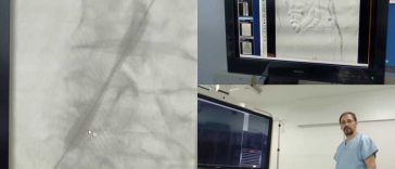 Buzău: Intervenție în premieră pentru desfundarea unei artere a piciorului; a fost montat un stent pe balon