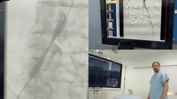 Buzău: Intervenție în premieră pentru desfundarea unei artere a piciorului; a fost montat un stent pe balon