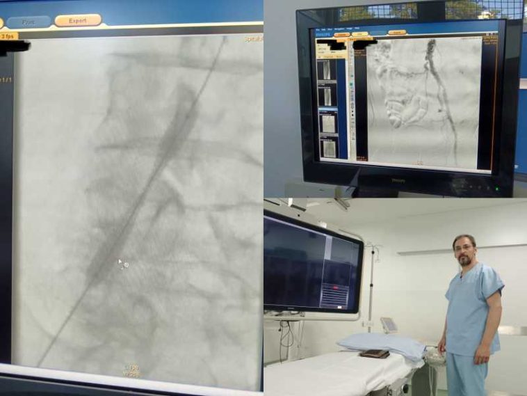 Buzău: Intervenție în premieră pentru desfundarea unei artere a piciorului; a fost montat un stent pe balon