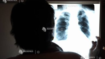 Semnal de alarmă transmis de specialiști și reprezentanți ai asociațiilor de pacienți cu prilejul Zilei Mondiale a Hipertensiunii Pulmonare