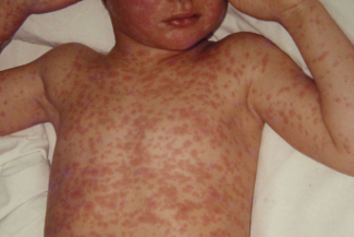 Avans important către dezvoltarea primului tratament din lume împotriva rujeolei: cercetătorii au identificat, în premieră, anticorpi umani cu potenţial de prevenire şi tratare a infecţiei cu virusul rujeolic