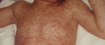 Avans important către dezvoltarea primului tratament din lume împotriva rujeolei: cercetătorii au identificat, în premieră, anticorpi umani cu potenţial de prevenire şi tratare a infecţiei cu virusul rujeolic