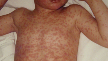 Avans important către dezvoltarea primului tratament din lume împotriva rujeolei: cercetătorii au identificat, în premieră, anticorpi umani cu potenţial de prevenire şi tratare a infecţiei cu virusul rujeolic