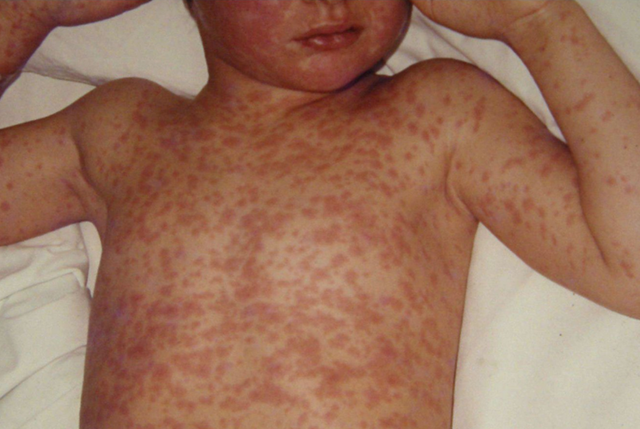 Avans important către dezvoltarea primului tratament din lume împotriva rujeolei: cercetătorii au identificat, în premieră, anticorpi umani cu potenţial de prevenire şi tratare a infecţiei cu virusul rujeolic