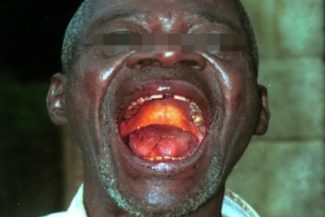 OMS anunţă că lansează săptămâna viitoare teste clinice ale unor tratamente împotriva ebola în RDC