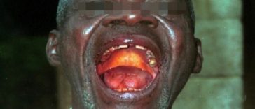 OMS anunţă că lansează săptămâna viitoare teste clinice ale unor tratamente împotriva ebola în RDC