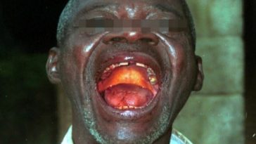 OMS anunţă că lansează săptămâna viitoare teste clinice ale unor tratamente împotriva ebola în RDC