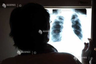 Anumiți pacienți cu cancer pulmonar în stadiu avansat ar putea fi salvați prin transplant (studiu)